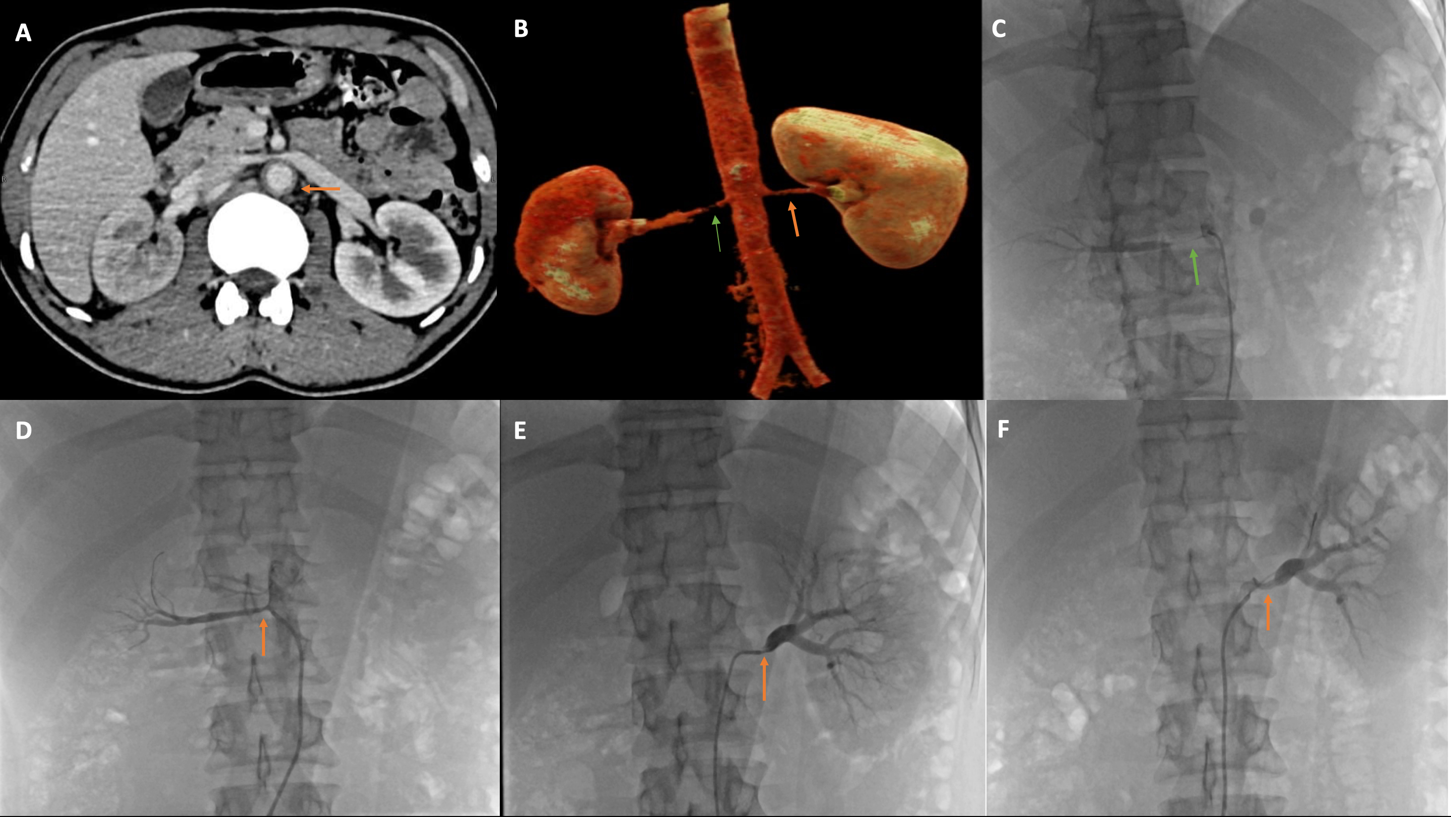 Coronary Angiography